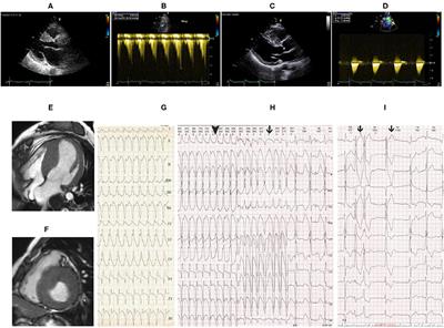 Aortic Coarctation Associated With Hypertrophic Cardiomyopathy in a Woman With Hypertension and Syncope: A Case Report With 8-Year Follow-Up